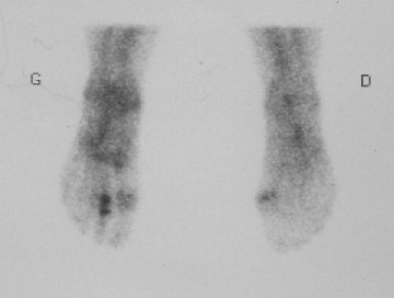 La scintigrahie met en évidence la fracture de fatigue : on observe une hyperfixation sur l'os lésé : la tache noire sur le deuxième orteil du pied gauche.