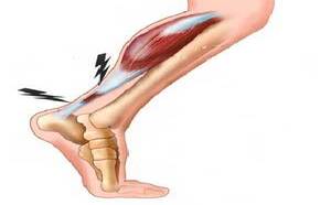 Le manque d'hydratation reste la cause principale de la tendinite du tendon d'Achille